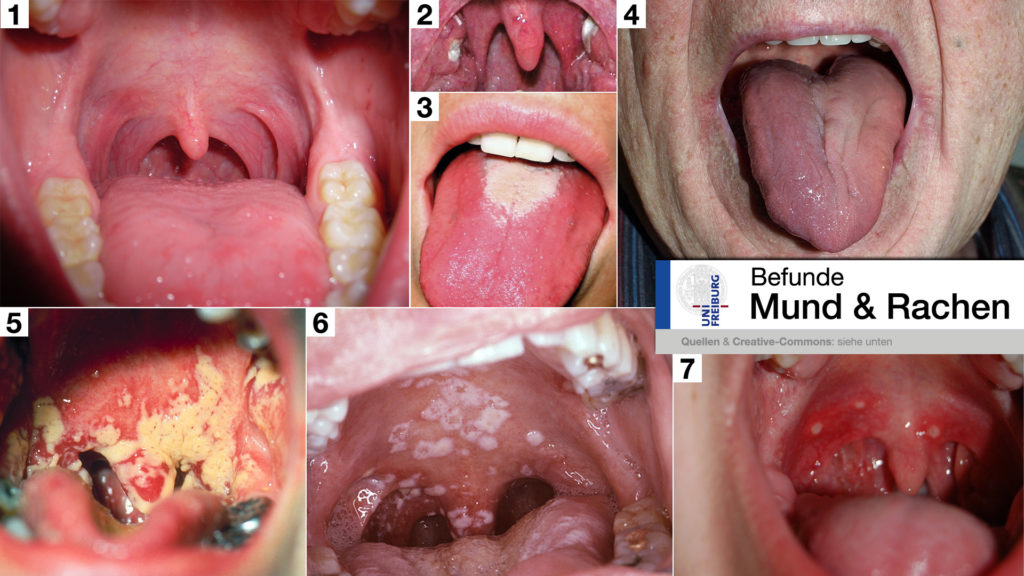 Ca tonsillen Tonsillitis