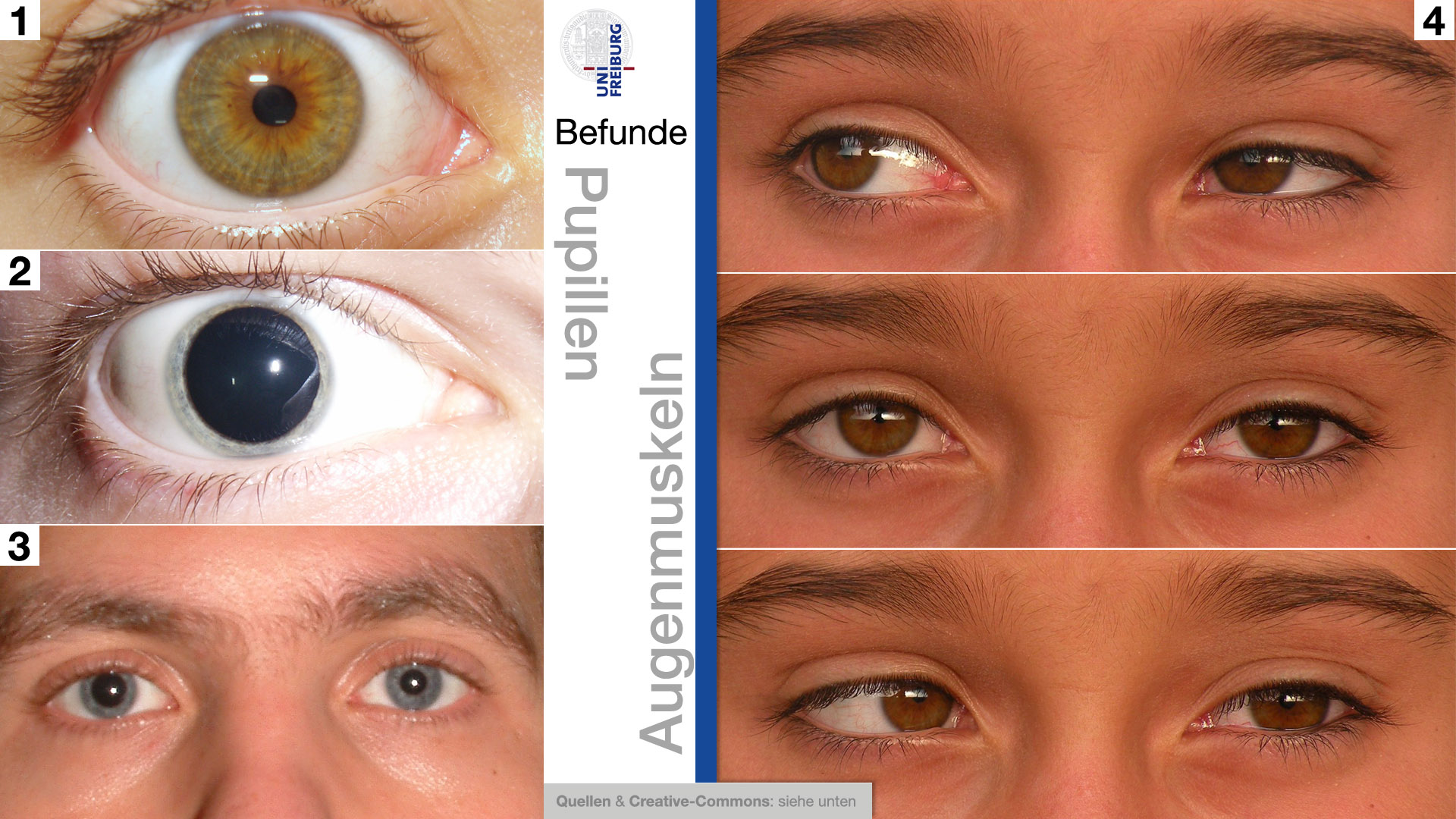 Befunde - Pupillen und Augenmuskeln: 1 Miosis, 2 Mydriasis (medikamentös he...